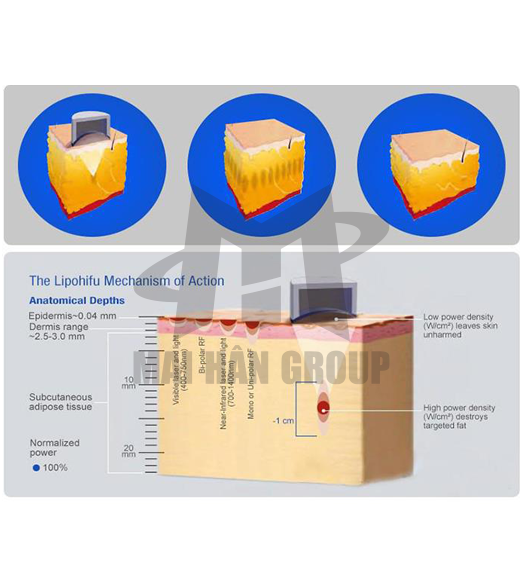 MÁY GIẢM BÉO LIPOSONIX 